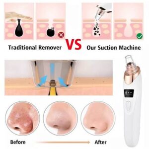 5 in 1 Electric Blackhead Remover